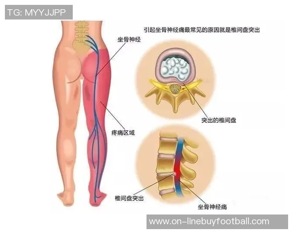 专家解读坐骨神经痛成因及治疗方法大多数患者可避免手术治疗